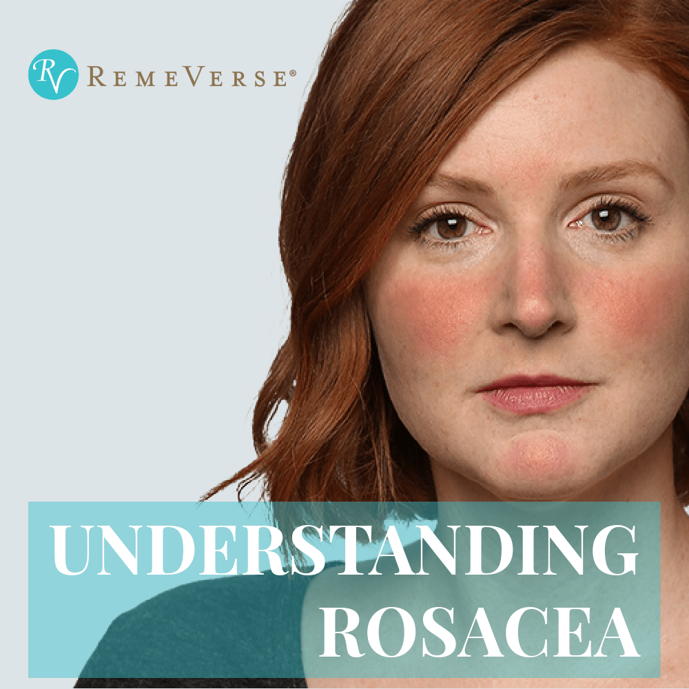 Understanding Rosacea